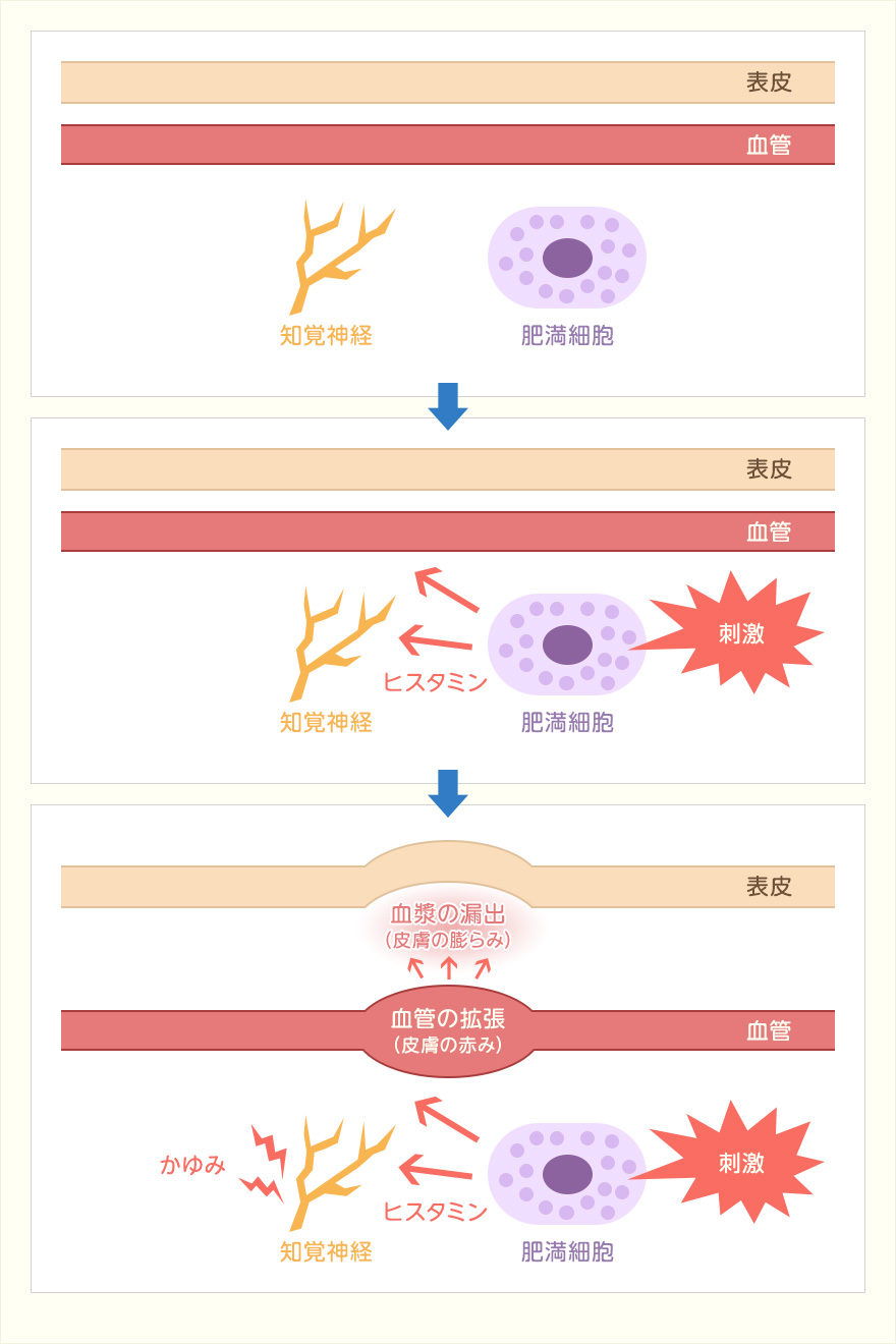 蕁麻疹の仕組み