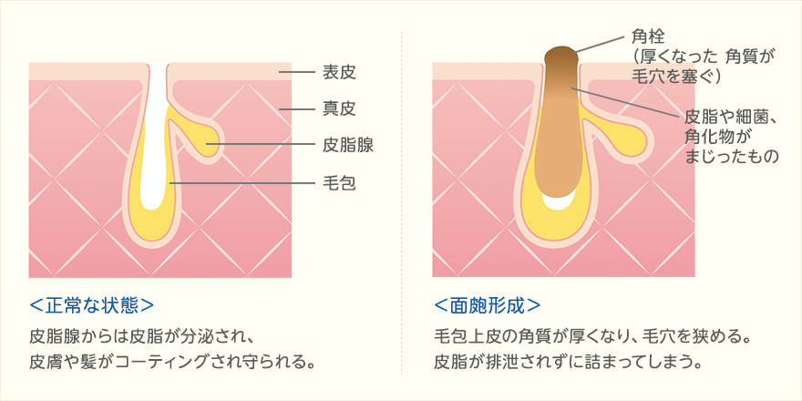 角栓の原因、仕組み