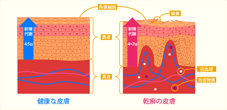 乾癬の仕組み
