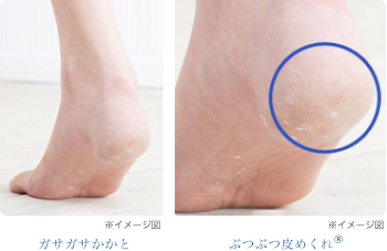 ガサガサかかと・ぶつぶつ皮めくれ®の写真